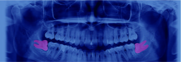 豊富な症例に対応した安全・正確な抜歯親知らずの抜歯専門外来